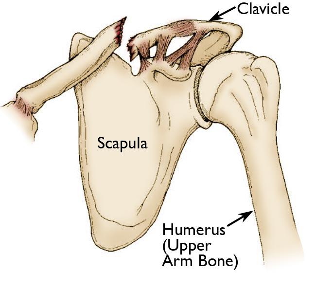 Clavicle Fractures