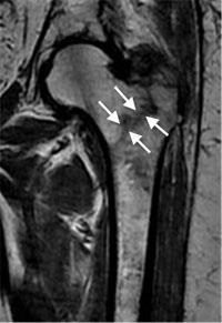 Hip Fractures