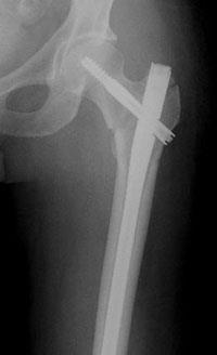 Intertrochanteric Fracture