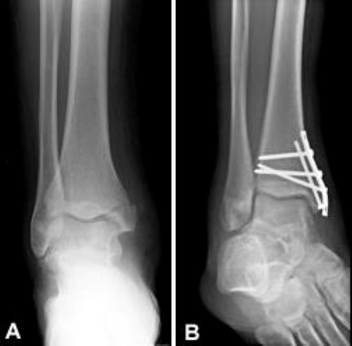 Surgical Treatment