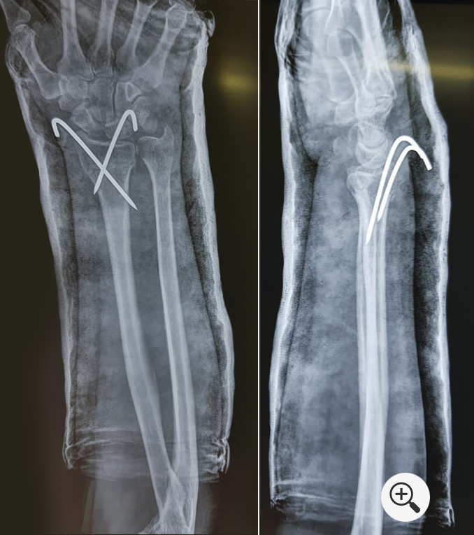 Distal Radius Fractures (Broken Wrist) | Trauma Surgery ...