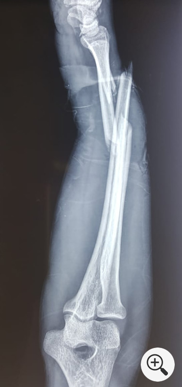 Forearm Fracture Symptoms